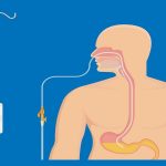 Enteral Feeding Devices Market