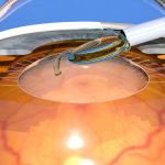 Intraocular Lens (IOL) Market