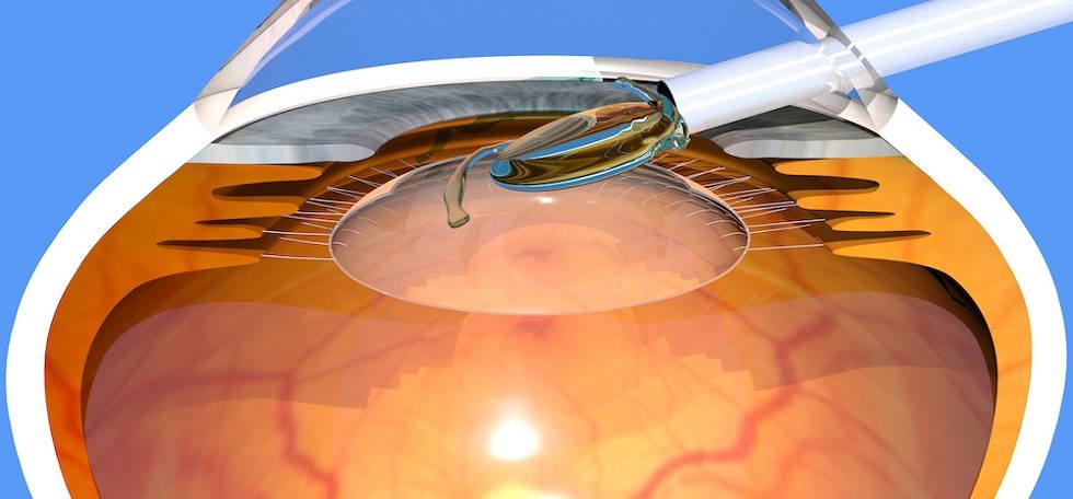 Intraocular Lens (IOL) Market