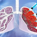 Interstitial Lung Disease ILD Treatment Market